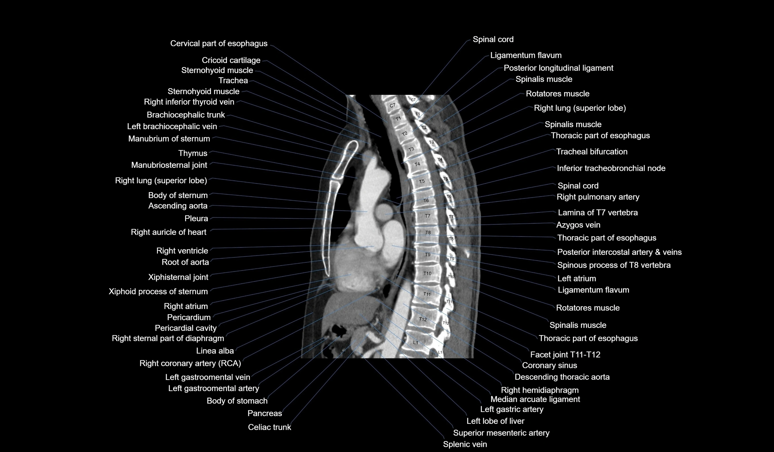 CT chest (thorax) soft tissue window labelled sagittal cross sectional anatomy radiology image-00075.webp